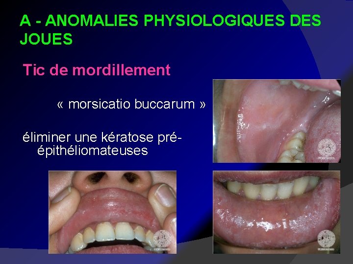 A - ANOMALIES PHYSIOLOGIQUES DES JOUES Tic de mordillement « morsicatio buccarum » éliminer