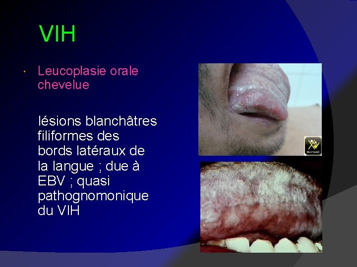  VIH Leucoplasie orale chevelue lésions blanchâtres filiformes des bords latéraux de la langue