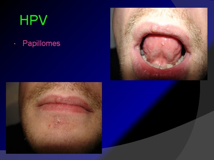  HPV Papillomes 