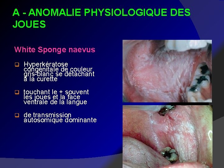 A - ANOMALIE PHYSIOLOGIQUE DES JOUES White Sponge naevus q Hyperkératose congénitale de couleur