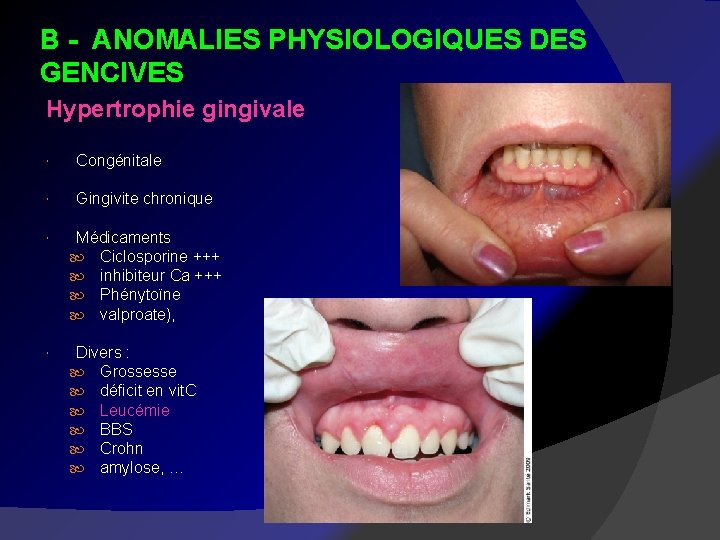 B - ANOMALIES PHYSIOLOGIQUES DES GENCIVES Hypertrophie gingivale Congénitale Gingivite chronique Médicaments Ciclosporine +++