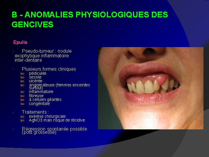 B - ANOMALIES PHYSIOLOGIQUES DES GENCIVES Epulis Pseudo-tumeur : nodule exophytique inflammatoire inter-dentaire Plusieurs