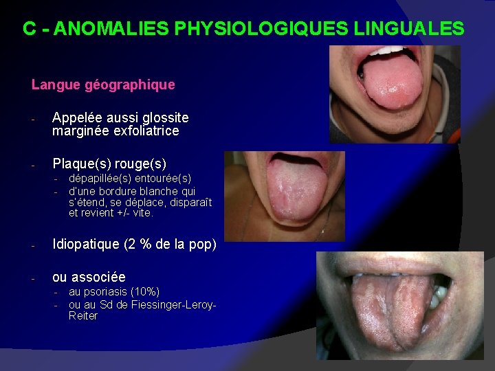 C - ANOMALIES PHYSIOLOGIQUES LINGUALES Langue géographique - Appelée aussi glossite marginée exfoliatrice -
