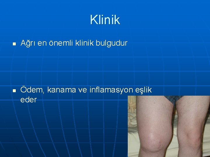 Klinik n n Ağrı en önemli klinik bulgudur Ödem, kanama ve inflamasyon eşlik eder