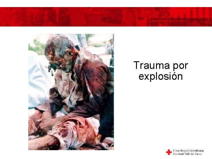 Trauma por explosión 