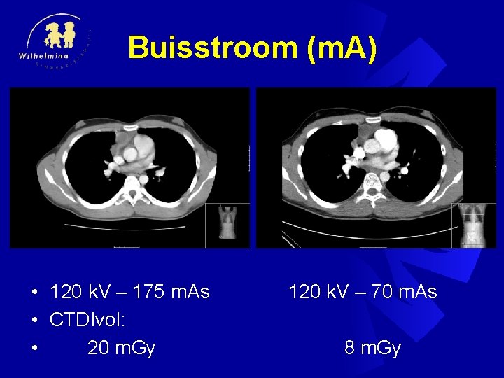 Buisstroom (m. A) • 120 k. V – 175 m. As • CTDIvol: •