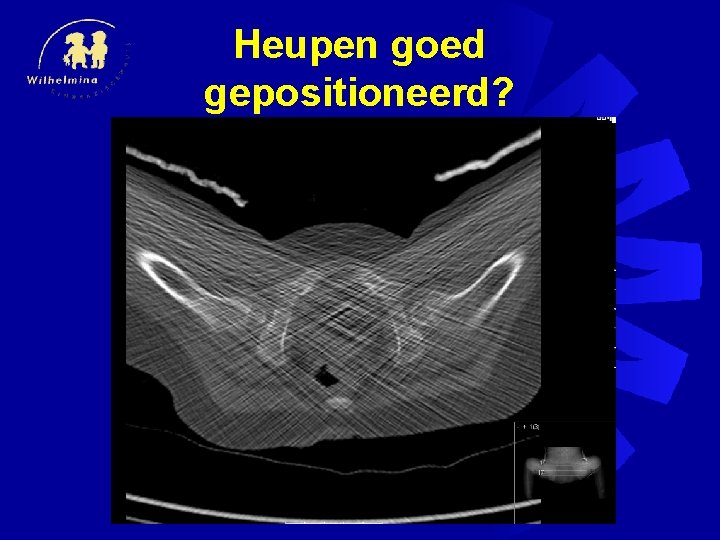 Heupen goed gepositioneerd? 