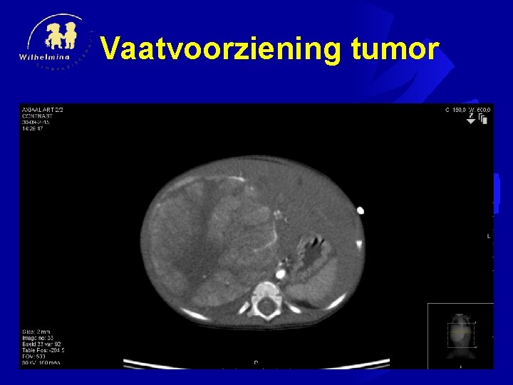 Vaatvoorziening tumor 