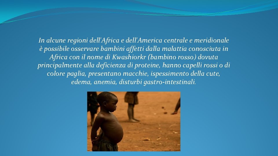 In alcune regioni dell'Africa e dell'America centrale e meridionale è possibile osservare bambini affetti