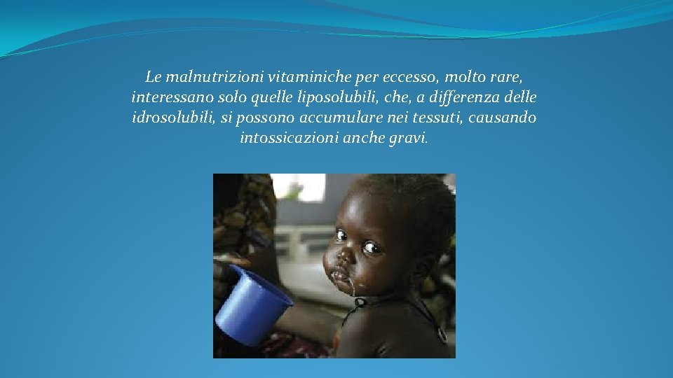 Le malnutrizioni vitaminiche per eccesso, molto rare, interessano solo quelle liposolubili, che, a differenza