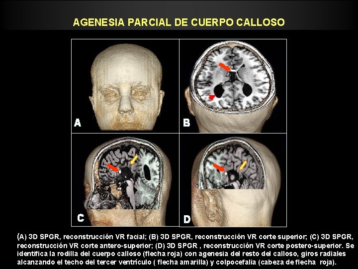 AGENESIA PARCIAL DE CUERPO CALLOSO A B C D (A) 3 D SPGR, reconstrucción