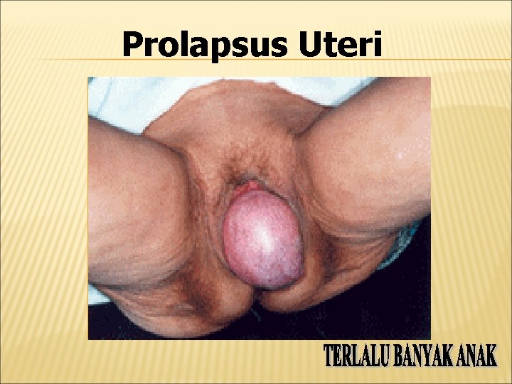 Prolapsus Uteri 