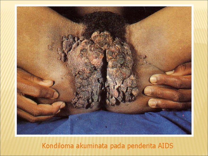 Kondiloma akuminata pada penderita AIDS 