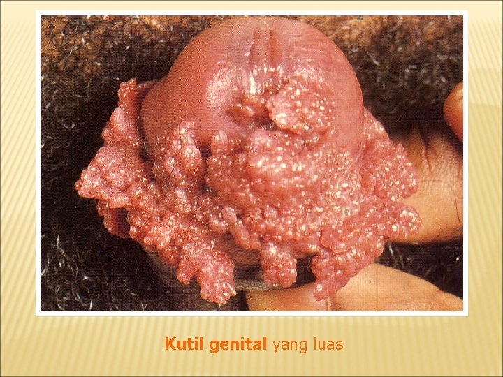 Kutil genital yang luas 