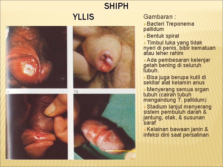 SHIPH YLLIS Gambaran : ØBacteri Treponema pallidum ØBentuk spiral ØTimbul luka yang tidak nyeri