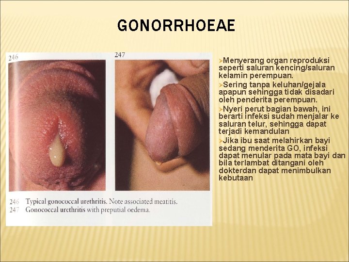 GONORRHOEAE ØMenyerang organ reproduksi seperti saluran kencing/saluran kelamin perempuan. ØSering tanpa keluhan/gejala apapun sehingga