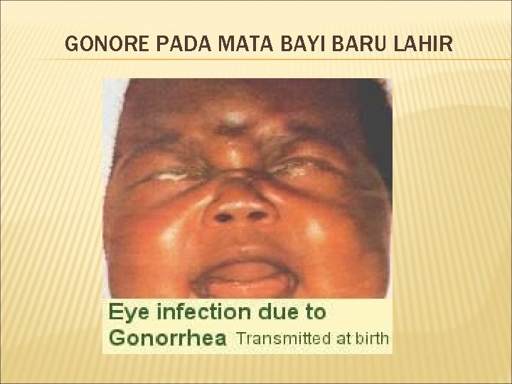 GONORE PADA MATA BAYI BARU LAHIR 