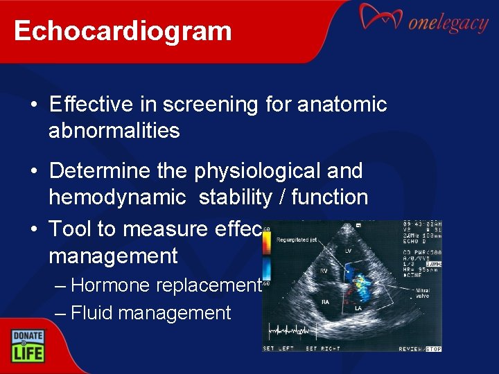 Echocardiogram • Effective in screening for anatomic abnormalities • Determine the physiological and hemodynamic
