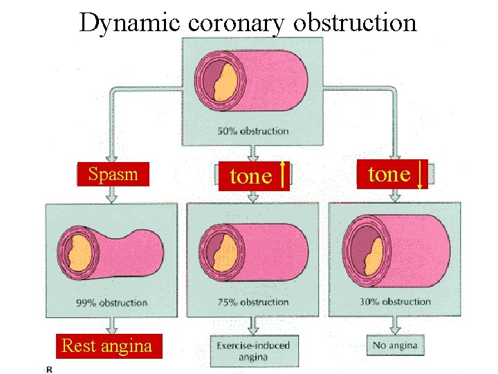 Dynamic coronary obstruction Spasm Rest angina tone 
