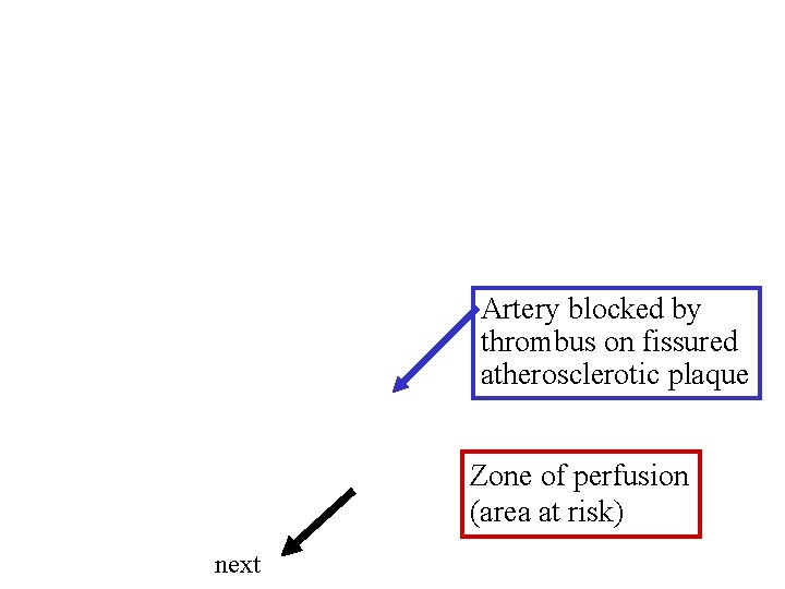 Artery blocked by thrombus on fissured atherosclerotic plaque Zone of perfusion (area at risk)