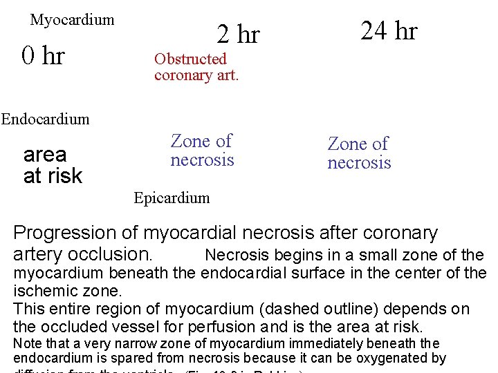 Myocardium 0 hr 24 hr Obstructed coronary art. Endocardium area at risk Zone of