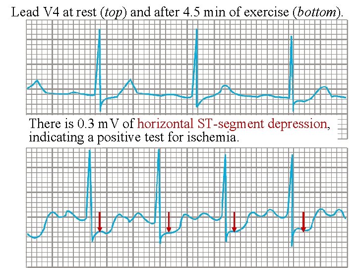 Lead V 4 at rest (top) and after 4. 5 min of exercise (bottom).