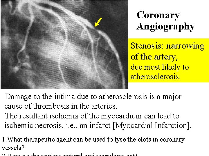 Coronary Angiography Stenosis: narrowing of the artery, due most likely to atherosclerosis. Damage to