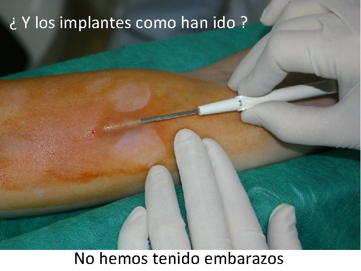 ¿ Y los implantes como han ido ? No hemos tenido embarazos 