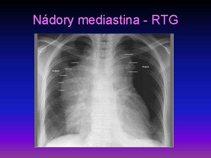 Nádory mediastina - RTG 
