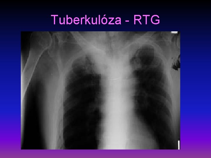 Tuberkulóza - RTG 