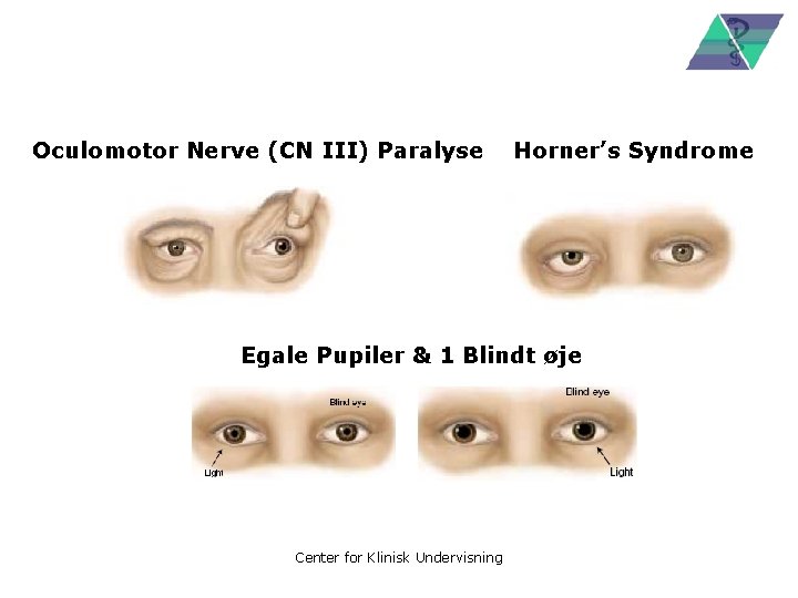 Oculomotor Nerve (CN III) Paralyse Horner’s Syndrome Egale Pupiler & 1 Blindt øje Center