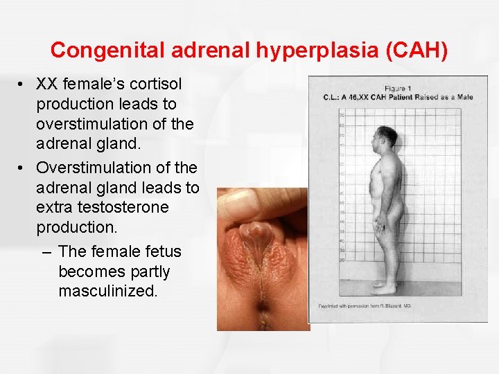 Congenital adrenal hyperplasia (CAH) • XX female’s cortisol production leads to overstimulation of the