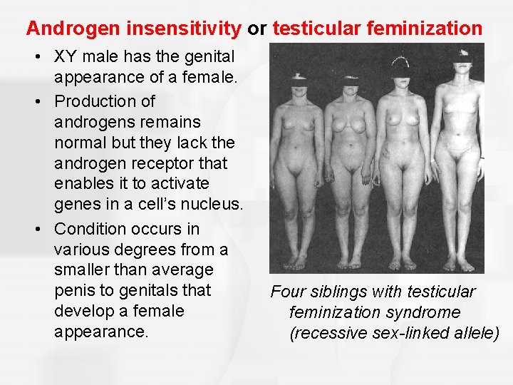 Androgen insensitivity or testicular feminization • XY male has the genital appearance of a