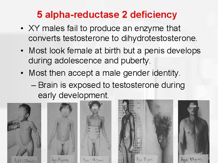 5 alpha-reductase 2 deficiency • XY males fail to produce an enzyme that converts