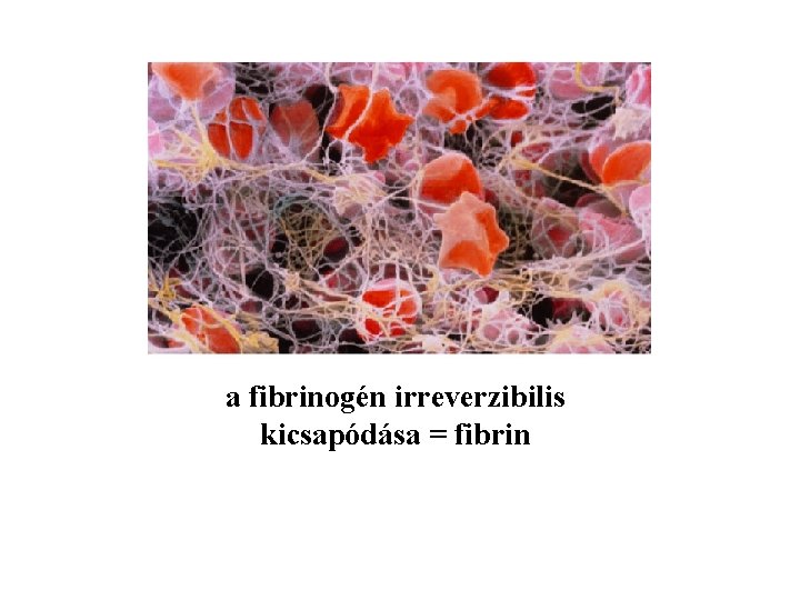 a fibrinogén irreverzibilis kicsapódása = fibrin 