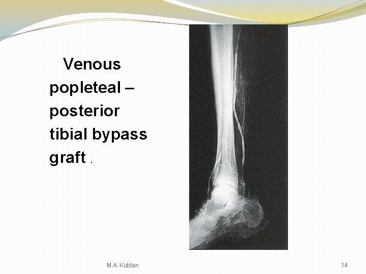 Venous popleteal – posterior tibial bypass graft. M. A. Kubtan 14 