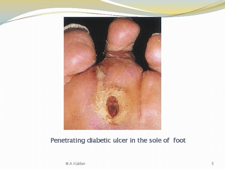 Penetrating diabetic ulcer in the sole of foot M. A. Kubtan 5 