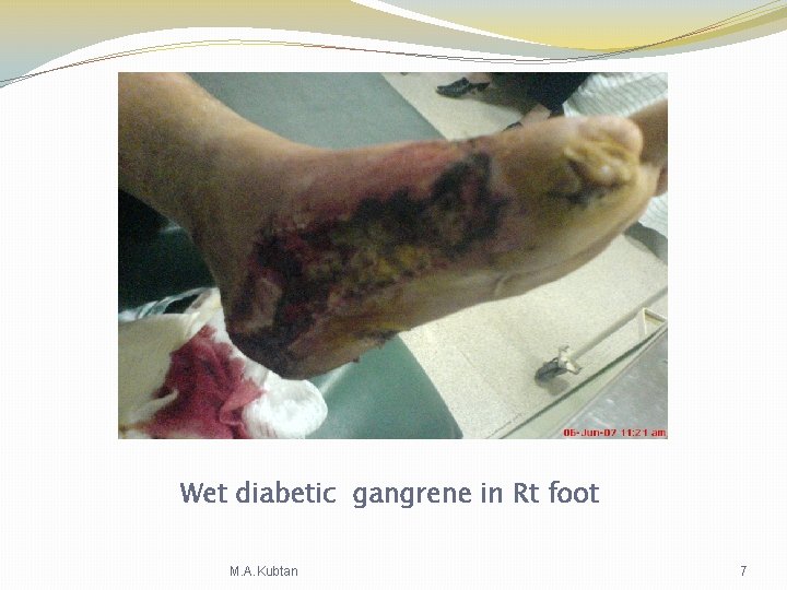 Wet diabetic gangrene in Rt foot M. A. Kubtan 7 