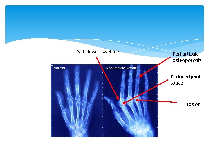 Soft tissue swelling Peri-articular osteoporosis Reduced joint space Erosion 