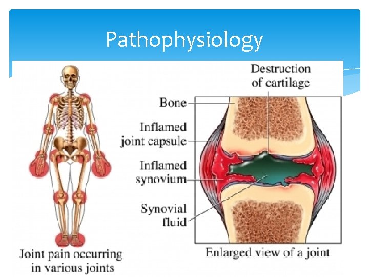 Pathophysiology Inflammatory cells infiltrate the synvoium and they proliferate Macrophages and osteoclasts create chronically
