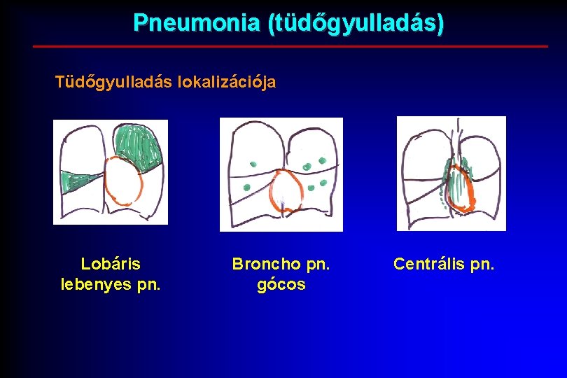 Pneumonia (tüdőgyulladás) Tüdőgyulladás lokalizációja Lobáris lebenyes pn. Broncho pn. gócos Centrális pn. 