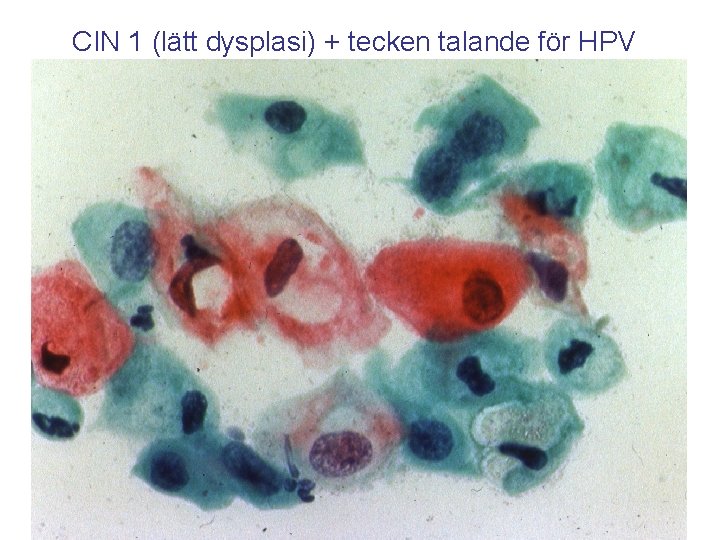 CIN 1 (lätt dysplasi) + tecken talande för HPV 