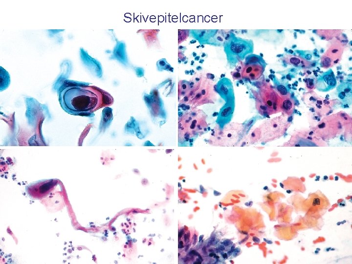 Skivepitelcancer 