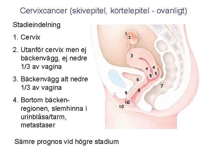 Cervixcancer (skivepitel, körtelepitel - ovanligt) Stadieindelning 1. Cervix 2. Utanför cervix men ej bäckenvägg,