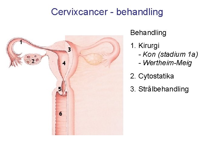 Cervixcancer - behandling Behandling 1. Kirurgi - Kon (stadium 1 a) - Wertheim-Meig 2.