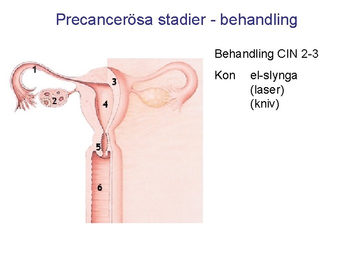 Precancerösa stadier - behandling Behandling CIN 2 -3 Kon el-slynga (laser) (kniv) 