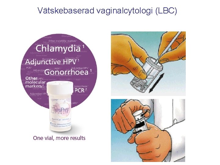 Vätskebaserad vaginalcytologi (LBC) 