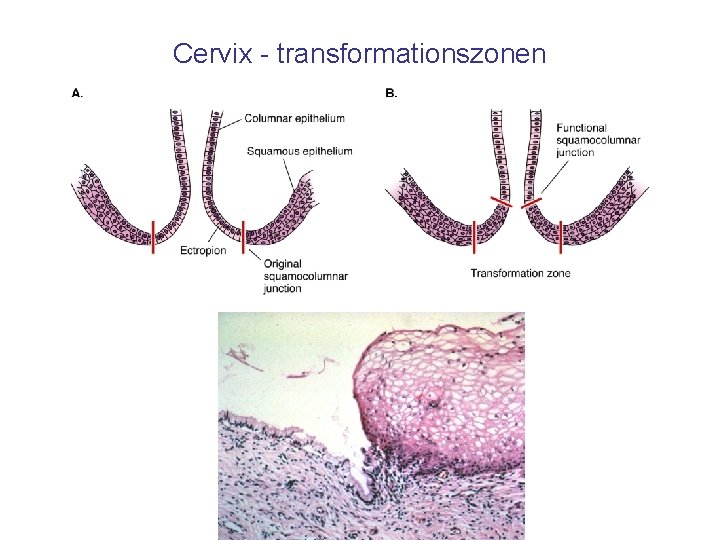 Cervix - transformationszonen 