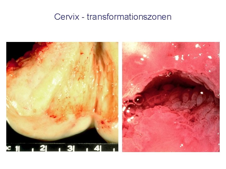 Cervix - transformationszonen 