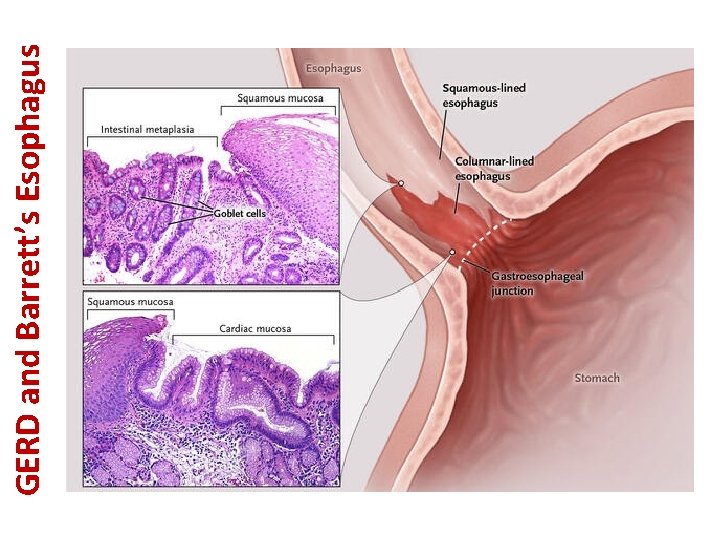 GERD and Barrett’s Esophagus 